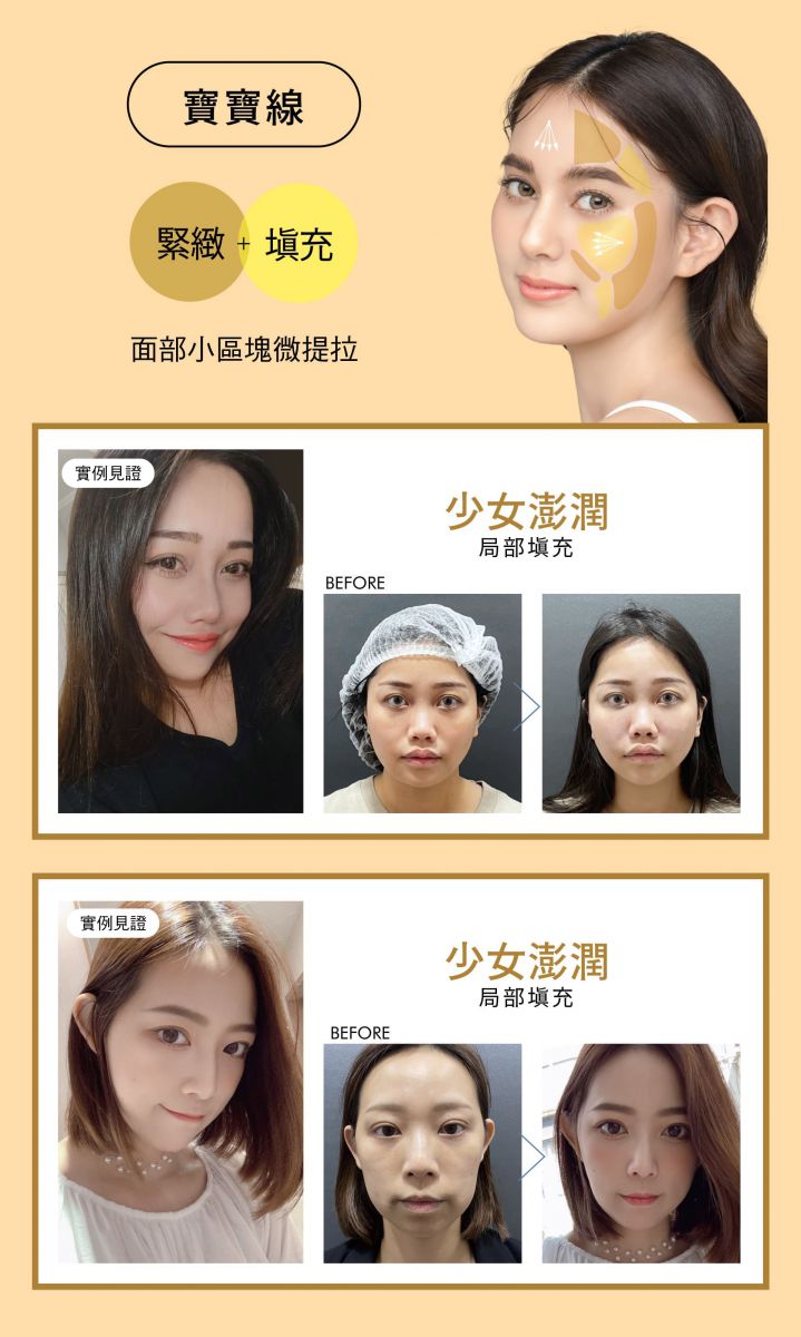 全方面解決衰老問題 HOW TO USE 寶寶線 緊緻+填充 面部小區塊微提拉 少女澎潤 局部填充