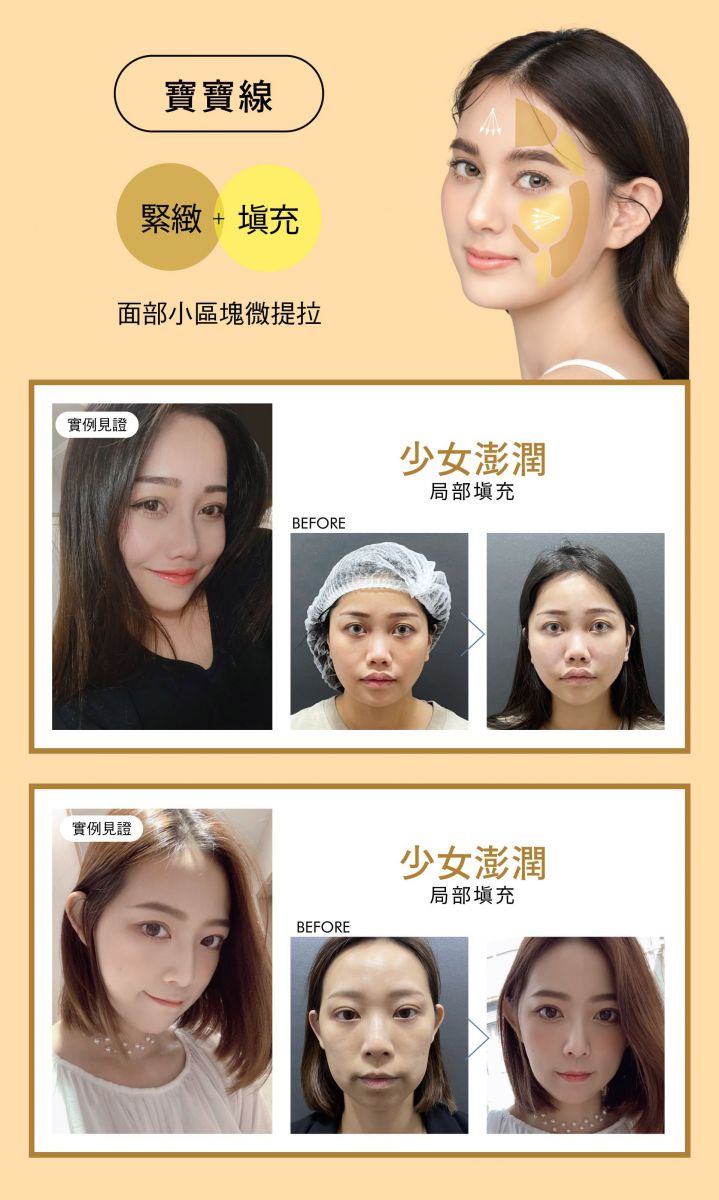 全方面解決衰老問題 HOW TO USE  寶寶線 緊緻+填充 面部小區塊微提拉 少女澎潤 局部填充