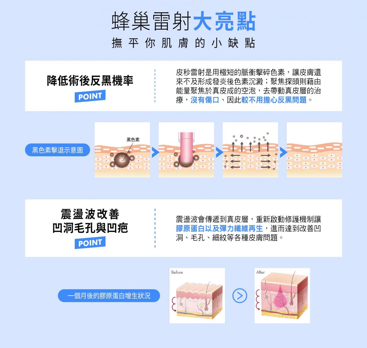 蜂巢雷射大亮點 撫平你肌膚的小缺點 降低術後反黑機率 皮秒雷射是用極短的脈衝擊碎色素,讓皮膚還來不及形成發炎後色素沉澱;聚焦探頭則藉由能量聚焦於真皮成的空泡,去帶動真皮層的治療,沒有傷口、因此較不用擔心反黑問題 震盪波改善凹洞毛孔與凹疤 震盪波會傳遞到真皮層,重新啟動修護機制讓膠原蛋白以及彈力纖維再生,進而達到改善凹洞、毛孔、細紋等各種皮膚問題。
