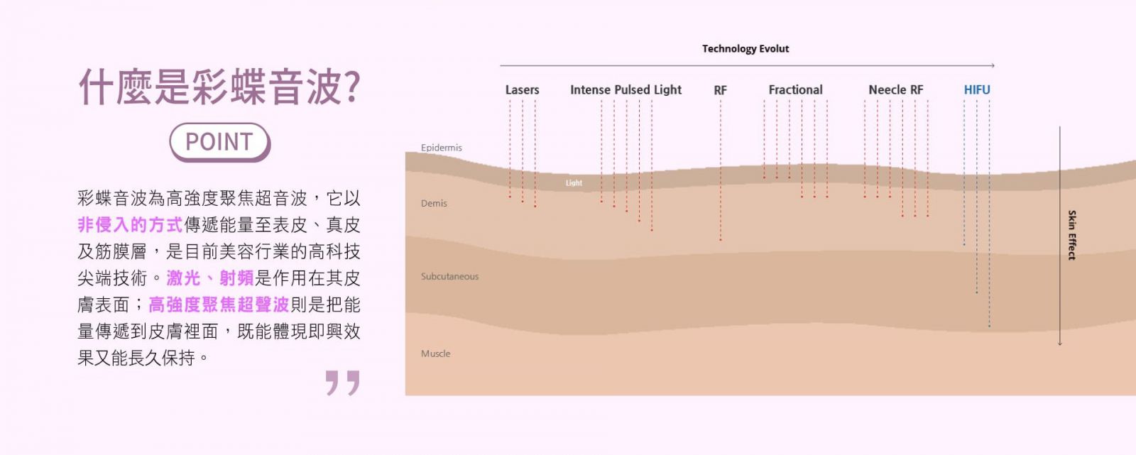 什麼是彩蝶音波? 彩蝶音波為高強度聚焦超音波,它以非侵入的方式傳遞能量至表皮、真皮及筋膜層,是目前美容行業的高科技尖端技術。激光、射頻是作用在其皮膚表面;高強度聚焦超聲波則是把能量傳遞到皮膚裡面,既能體現即興效果又能長久保持。