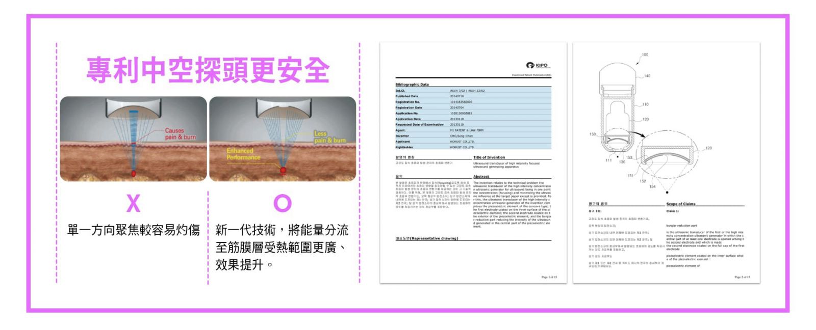 利中空探頭更安全 單一方向聚焦較容易灼傷,新一代技術,將能量分流至筋膜層受熱範圍更廣、效果提升。